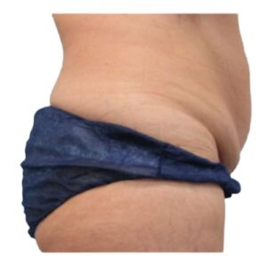 Belly of a patient before being treated
